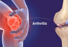 Arthritis